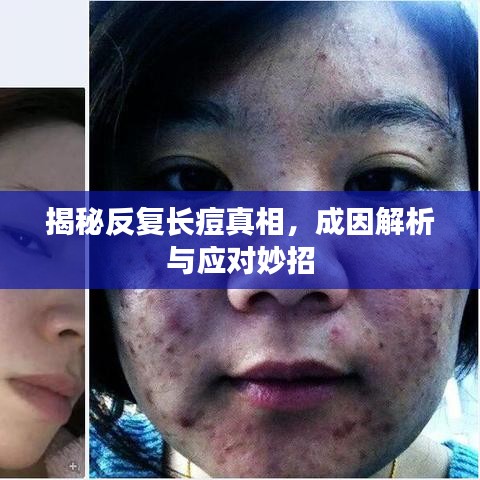 揭秘反復(fù)長痘真相，成因解析與應(yīng)對妙招