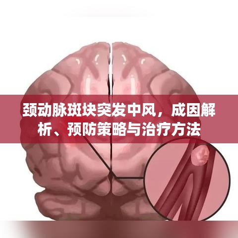 頸動脈斑塊突發(fā)中風(fēng)，成因解析、預(yù)防策略與治療方法